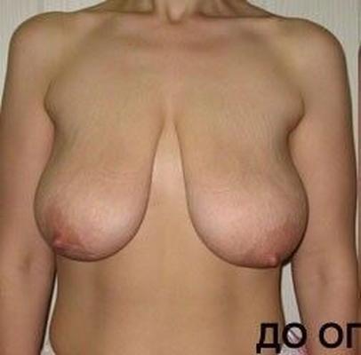 Breasts Normal Cupsize