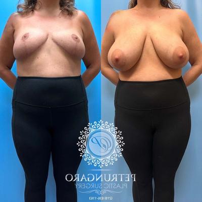 Pre Op Breast Reduction Collection 14